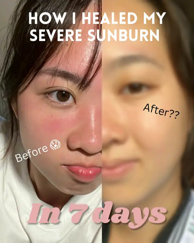 How I repaired a SEVERE sunburn in 7 days