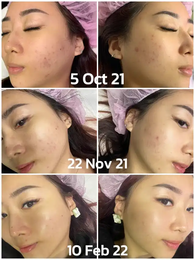 If facial is not helping your acne, TRY THIS!