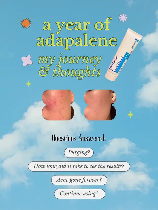 Adapalene gel for a year and here’s what happened